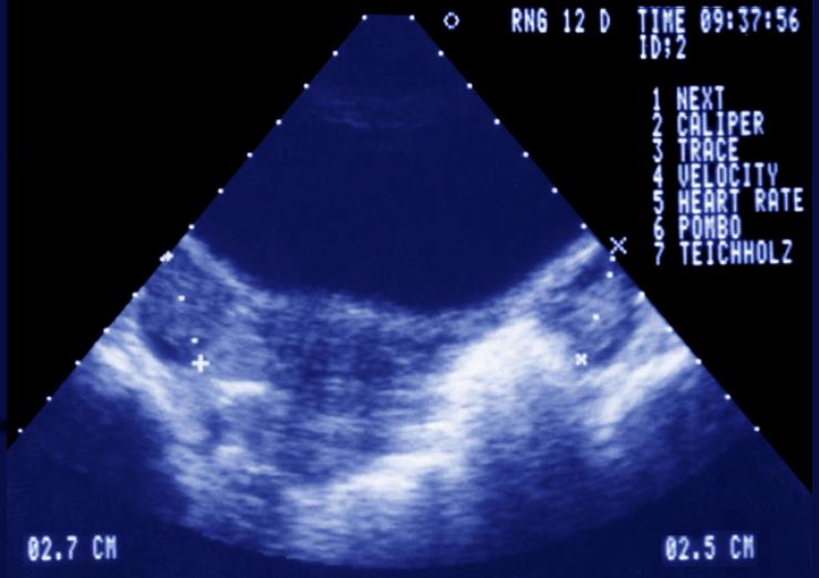 Gynecological Ultrasound. Ovarian Dystrophy. (Photo By BSIP/UIG Via Getty Images)