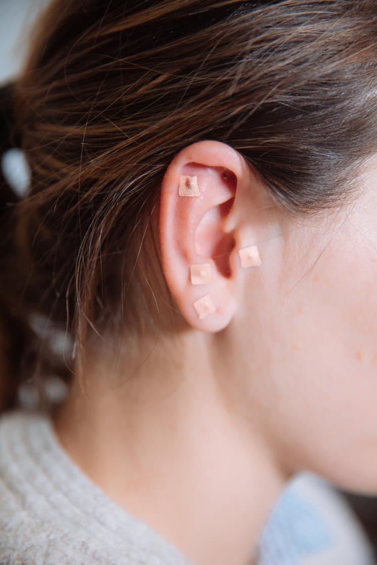 acupuncture needles in the ear